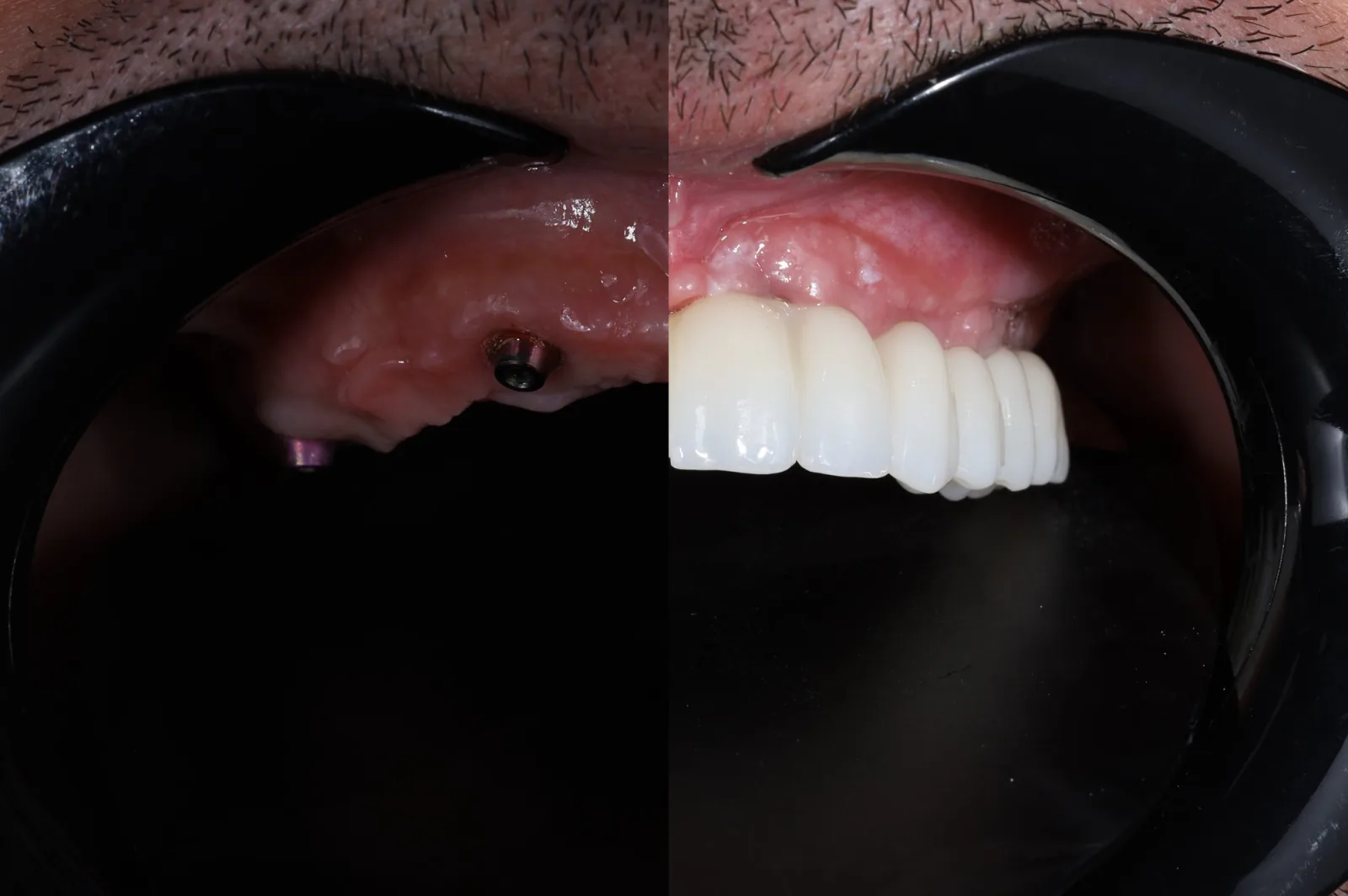 Протезування зубів — результат лікування